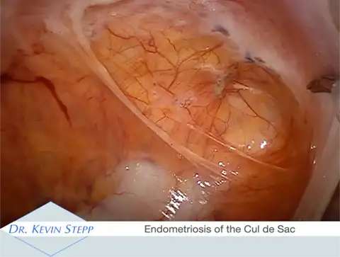 endometriosis of the cul de sac
