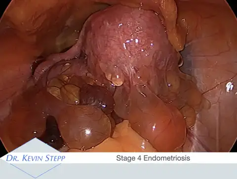 Stage 4 endometriosis