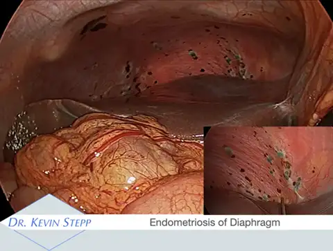 endometriosis of the diaphragm