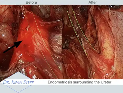 endometriosis surrounding the ureter