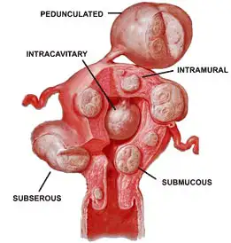 medical illustration showing fibroids